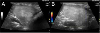 Case Report: Giant axillary lipoma in an infant